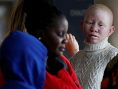 United States: Broader Action Required to Enhance Lives of Individuals with Albinism and HPS, Says UN Expert