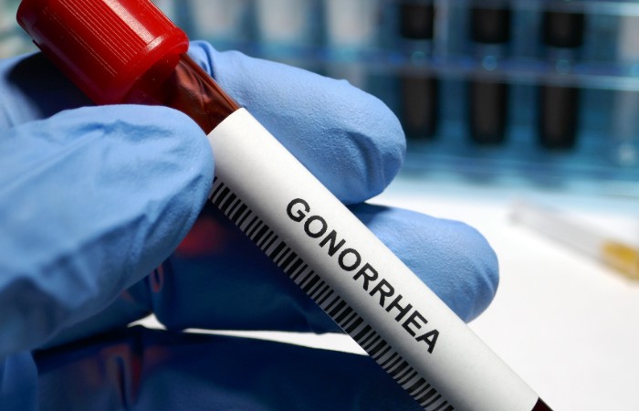 World-First Gonorrhoea Vaccination Programme: A Landmark Moment for Sexual Health in England and Wales